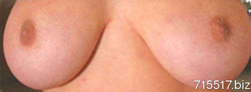 Chapallone
